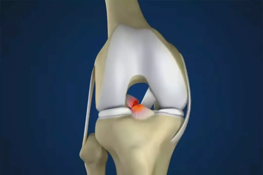 5 Types of ACL Grafts: Your Complete Reconstruction Options