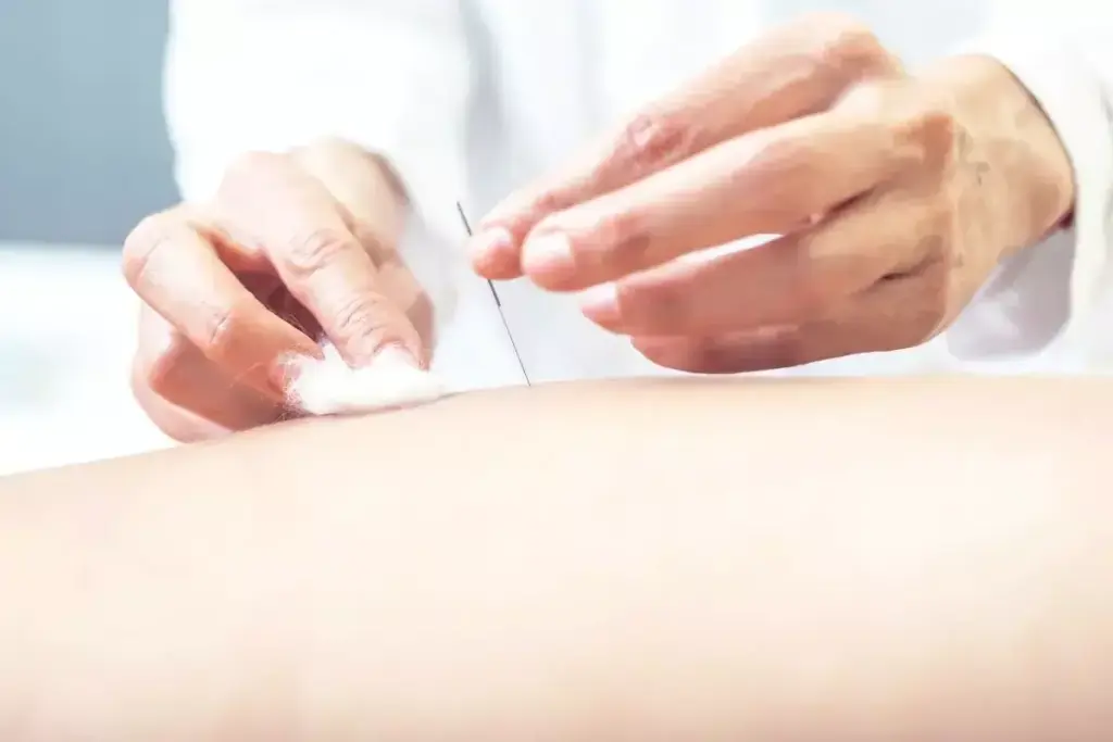 What Is Acupuncture and How Does It Really Work? 1 image 3607 LIV Hospital