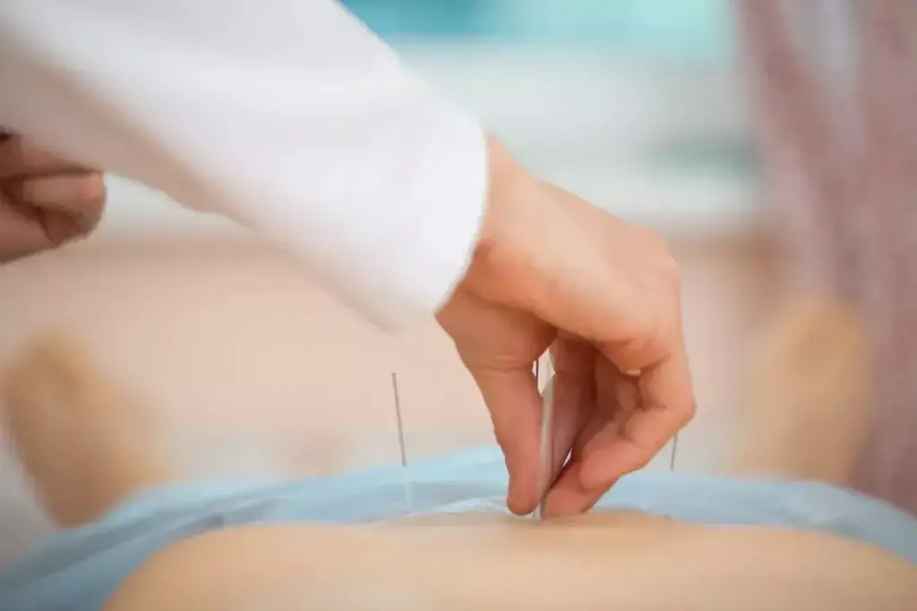 What Is Acupuncture and How Does It Really Work? 2 image 3608 LIV Hospital