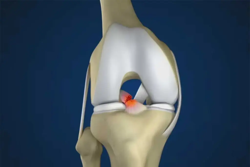 5 Types of ACL Grafts: Your Complete Reconstruction Options