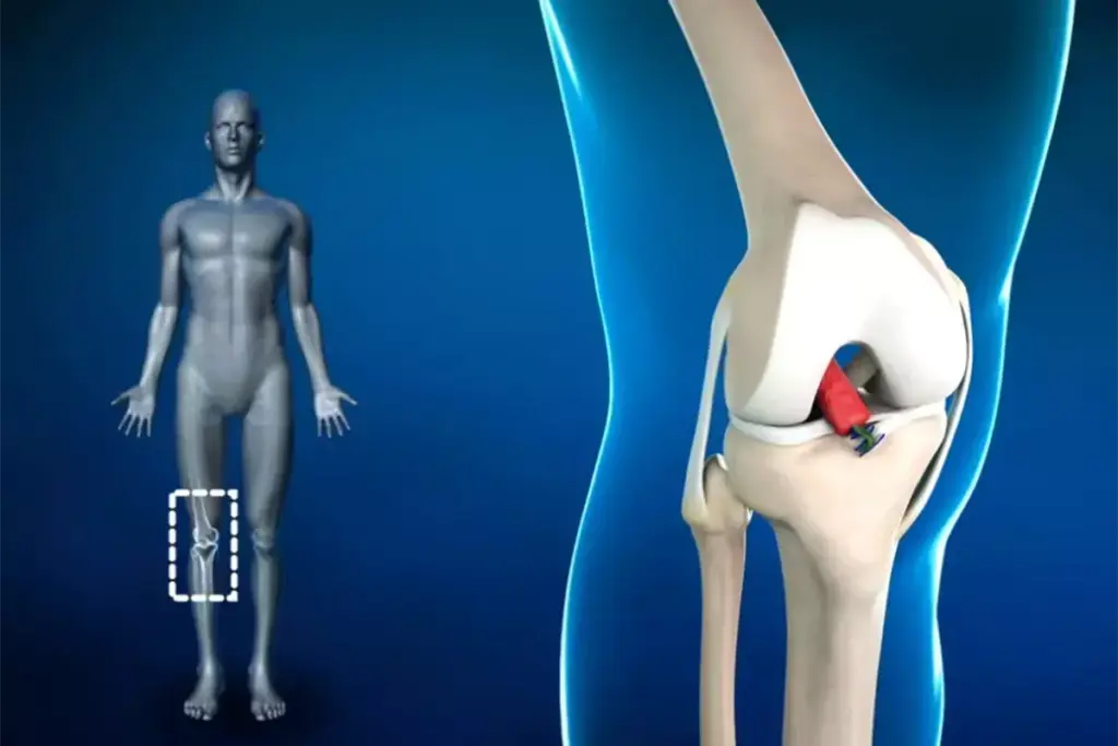 Can a Torn ACL Heal On Its Own Without Surgery?