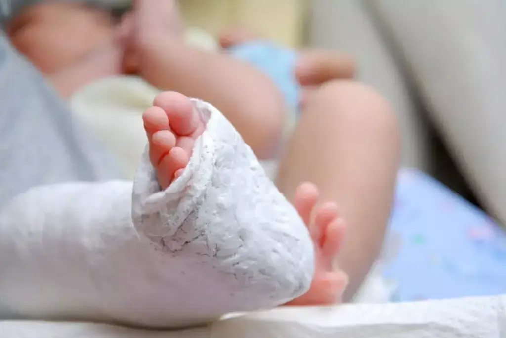 How to Fix Clubfoot in Babies: Treatment Options 2 How to Fix Clubfoot in Babies: Treatment Options