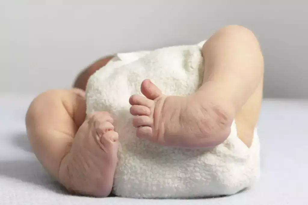 How to Fix Clubfoot in Babies: Treatment Options 3 How to Fix Clubfoot in Babies: Treatment Options