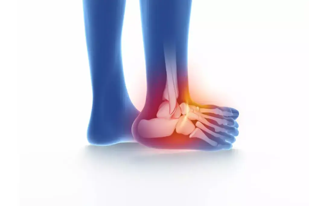 How to Treat a Torn Calcaneofibular Ligament 2 image 4291 LIV Hospital