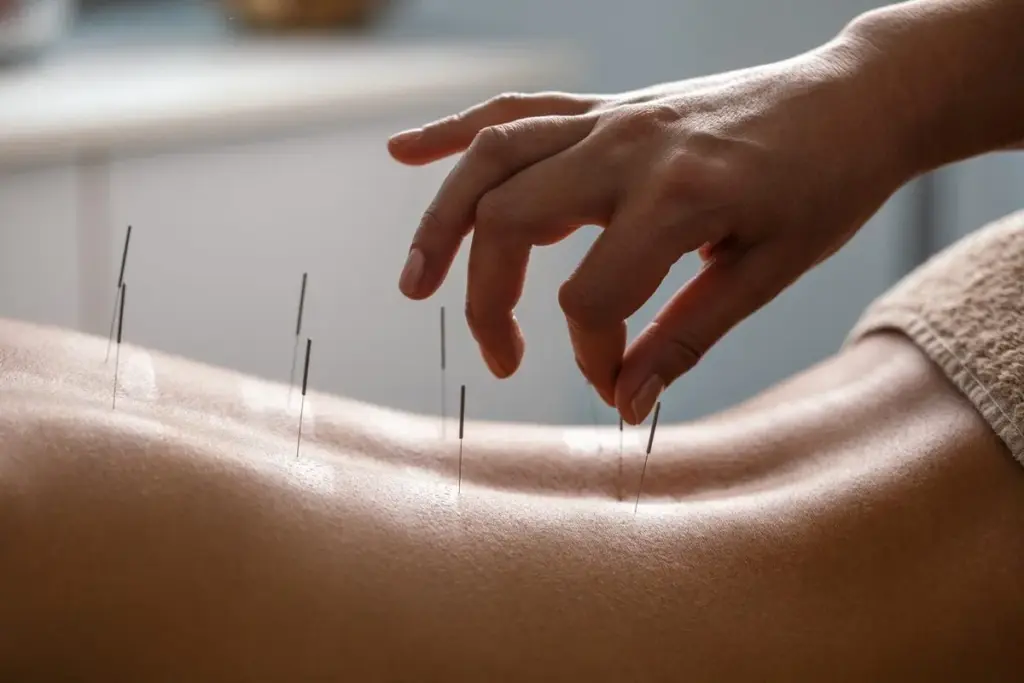 7 Benefits of Acupuncture: What It Treats and How It Works