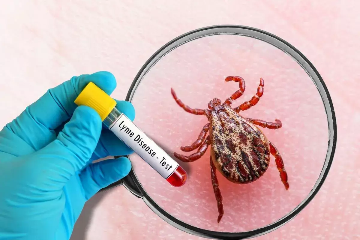 How to Treat Lyme Spirochetes: A Complete Guide