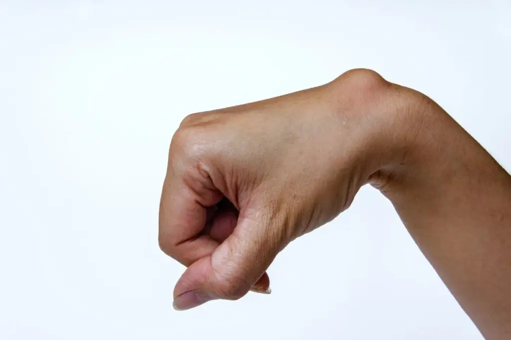 What Causes a Lump on Your Wrist With Carpal Tunnel?