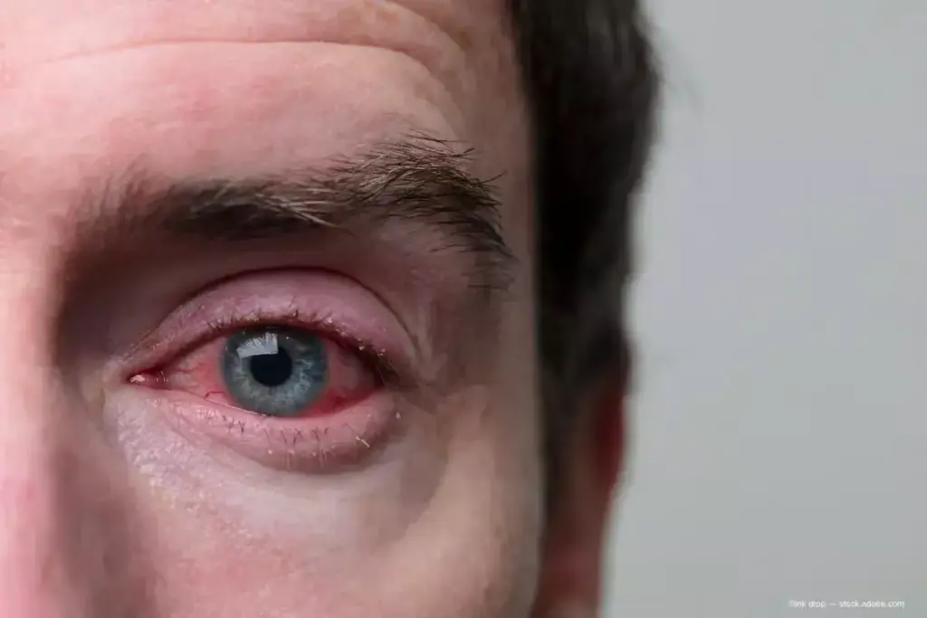Understanding Follicular Conjunctivitis
