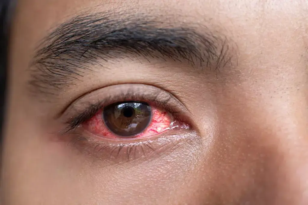 Understanding Pink Eye: Types and Symptoms