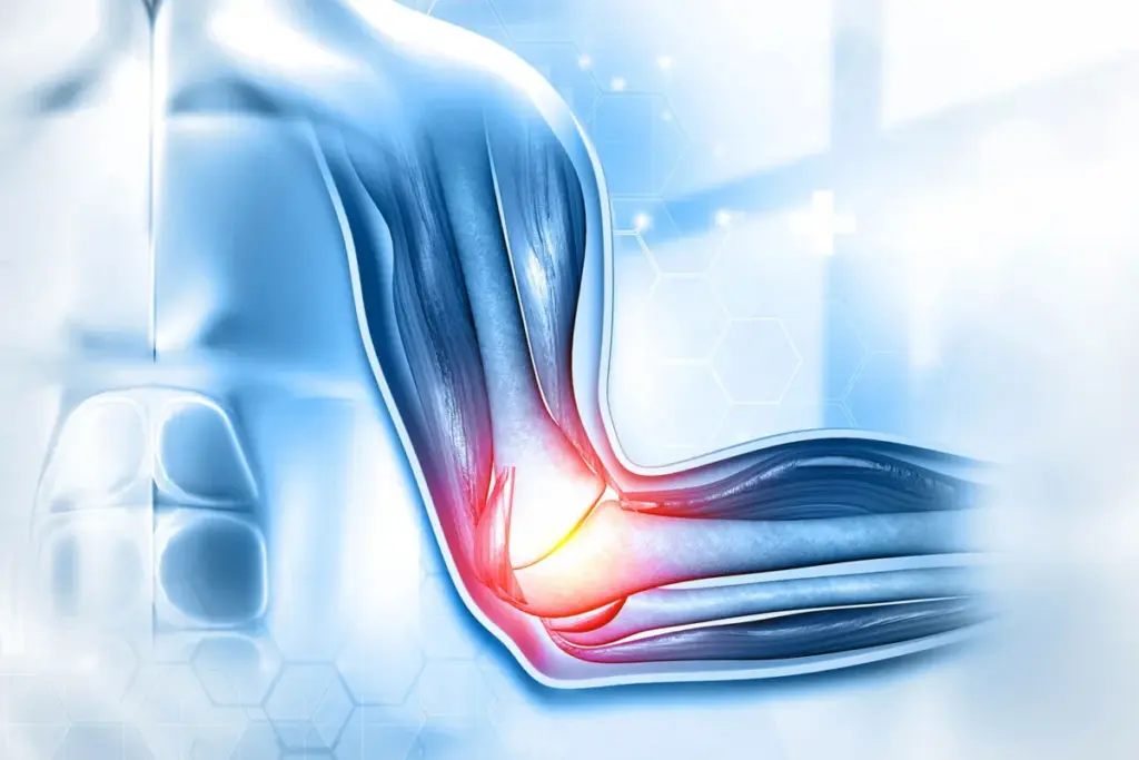 How to Treat a Collateral Ligament Rupture