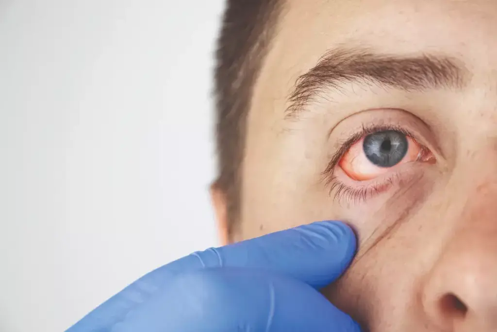 Understanding Bacterial Conjunctivitis in Infants