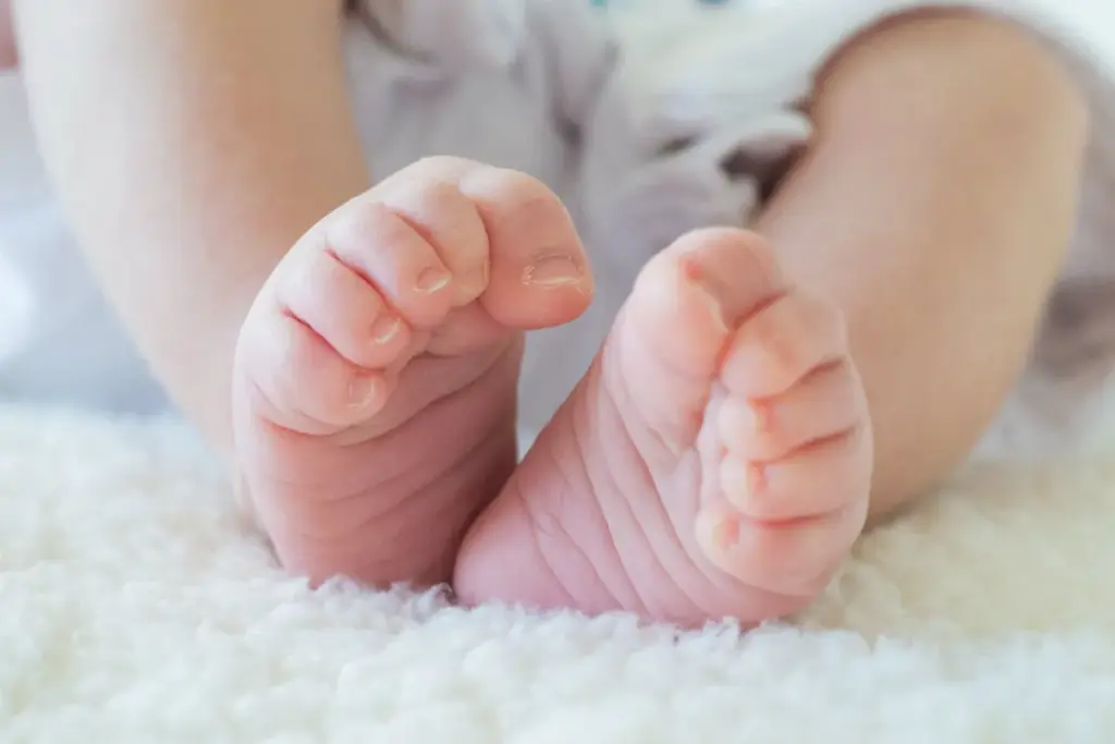 How to Use Ponseti Cast for Clubfoot Treatment