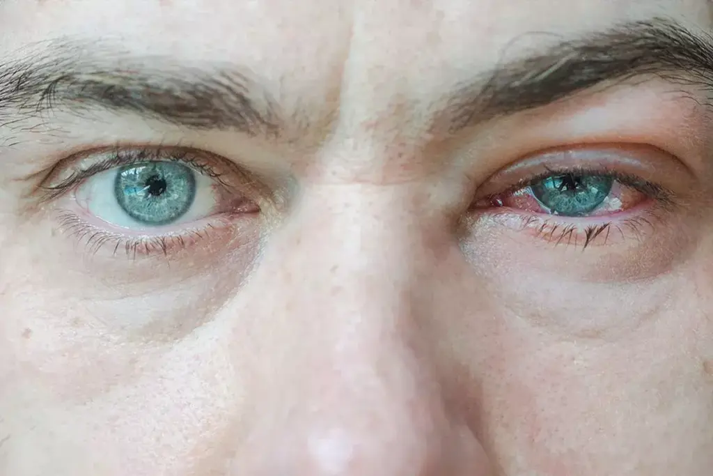 Understanding Viral Keratoconjunctivitis (EKC)