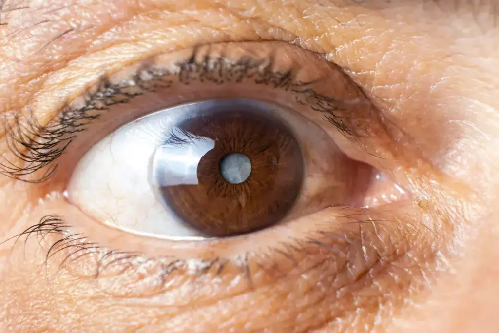 Promising Research on Non-Surgical Cataract Treatments