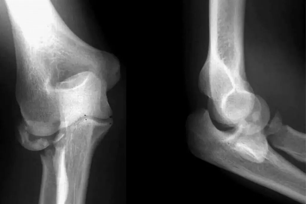 How to Treat a Calcaneofibular Ligament Strain