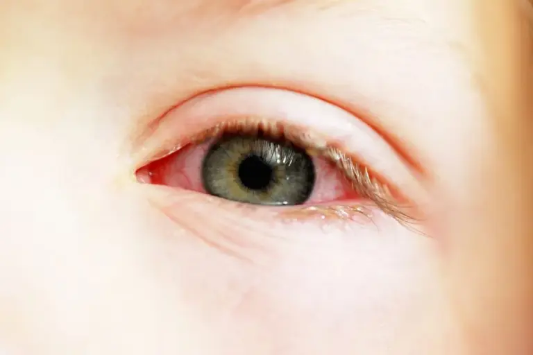 How to Treat Viral Keratoconjunctivitis: EKC Management Guide