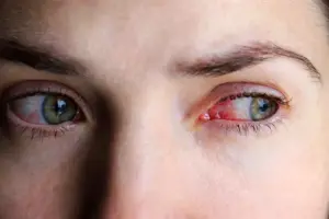 Is Shingles in the Eye Contagious? What You Need to Know About Pink Eye and Shingles