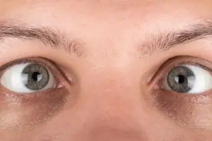 5 Signs of Mild Strabismus: Eye Misalignment Explained