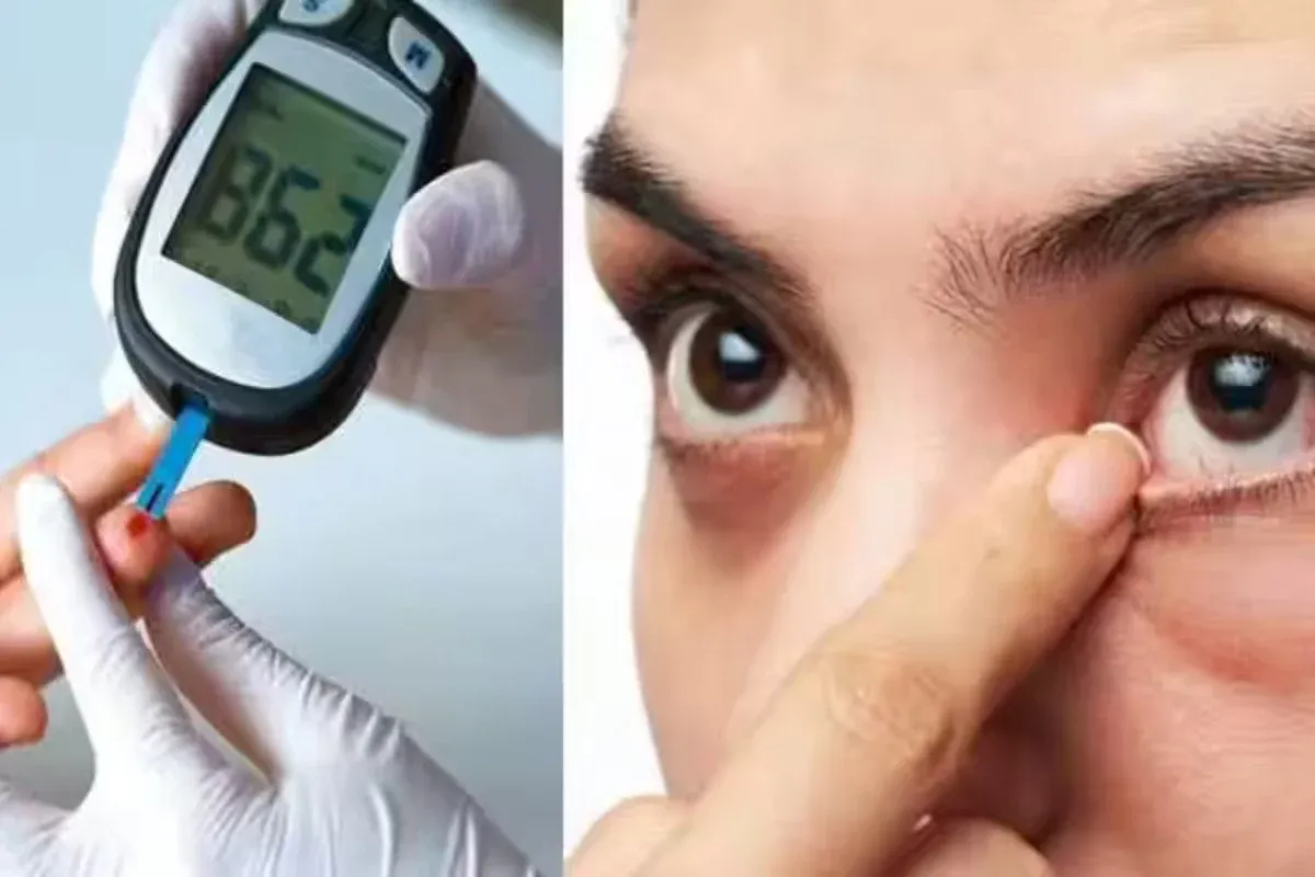 Does Diabetes Cause Glaucoma? Understanding the Link Between Blood Sugar and Eye Health