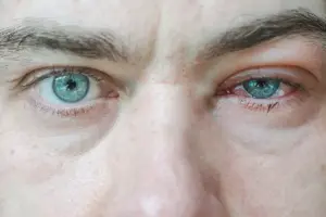 7 Natural Remedies for Pink Eye: Castor Oil, Coconut Oil & Herbs