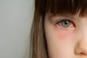 How to Treat Bacterial Conjunctivitis: Antibiotics Guide