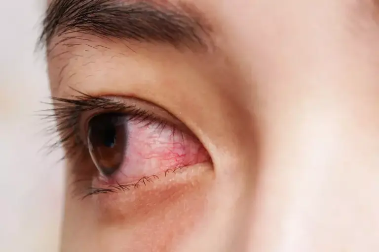 Does Pink Eye Cause Fever? What You Need to Know