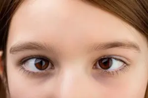 Is Cross Eyes Genetic? Understanding Strabismus and Lazy Eye Heredity