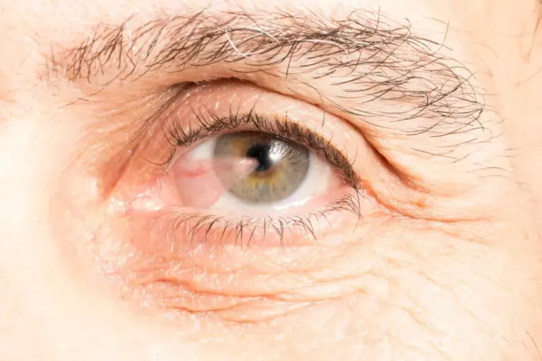 What’s the Difference Between Pinguecula and Pterygium?