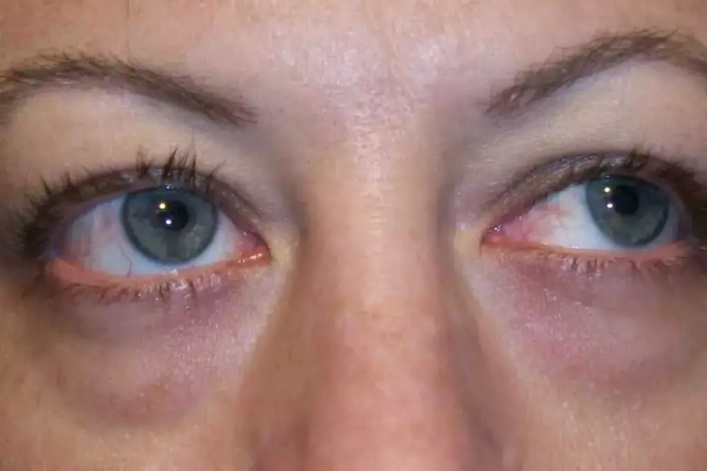 How to Get Rid of Sunken Eyes: 7 Effective Solutions 2 image 6584 LIV Hospital