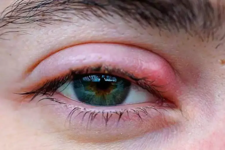 How to Treat Scleritis: Swollen Eye Sclera Relief
