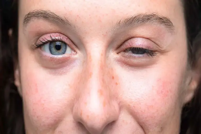 What Causes Weak Eye Muscles and What Are the Symptoms?