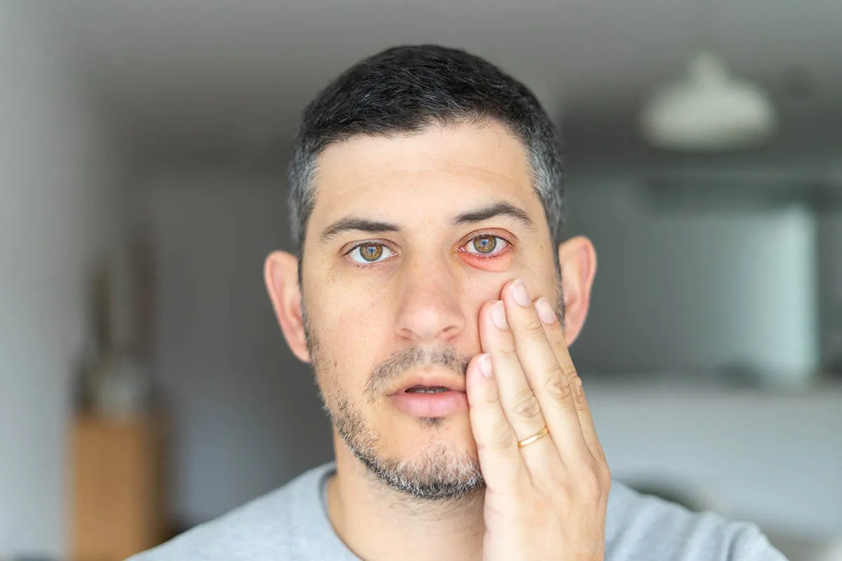 How to Tell if Conjunctivitis is Viral or Bacterial?