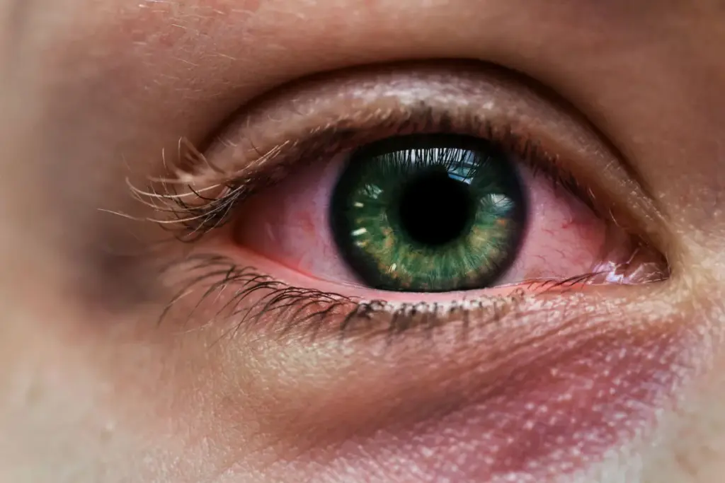 How Long Is Pink Eye Contagious After Starting Treatment?