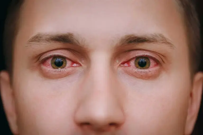 How to Use Polymyxin B Sulfate and Trimethoprim for Pink Eye