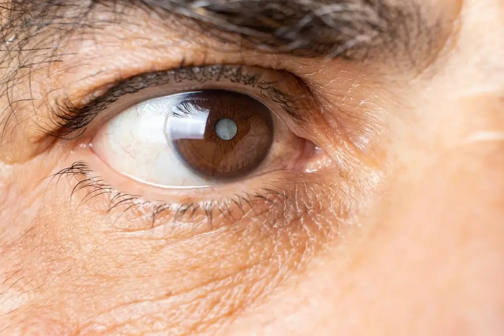 Common Symptoms of Nuclear Senile Cataracts