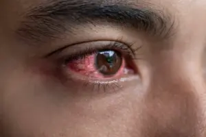 How to Get Rid of Red Eyes: 10 Home Remedies