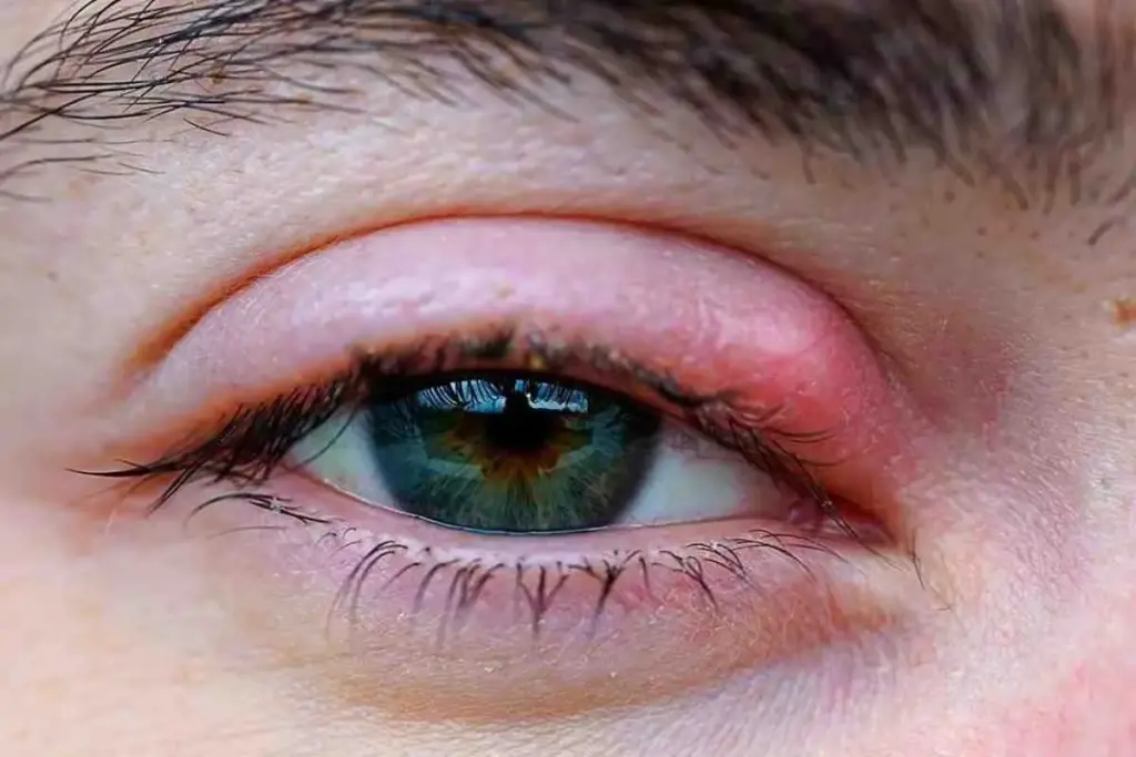 How to Treat Scleritis: Swollen Eye Sclera Relief
