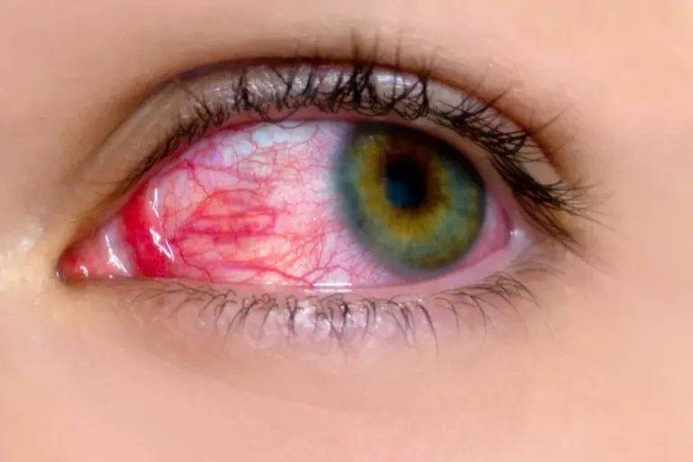 Can Strep Throat Cause Conjunctivitis and Eye Infections?