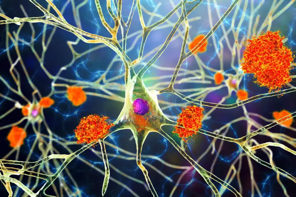 Amyloid Pet Scan: Amazing Truths For Patients