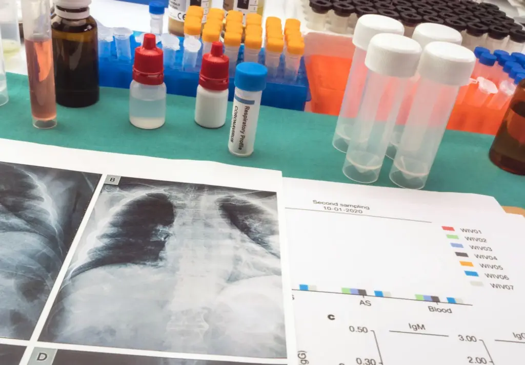 Lung Cancer Early Stage Finger Clubbing