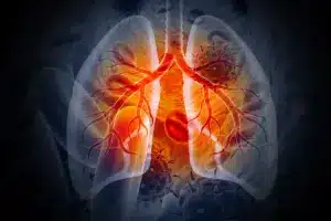 Lung Cancer Symptoms: Scary Starting Points