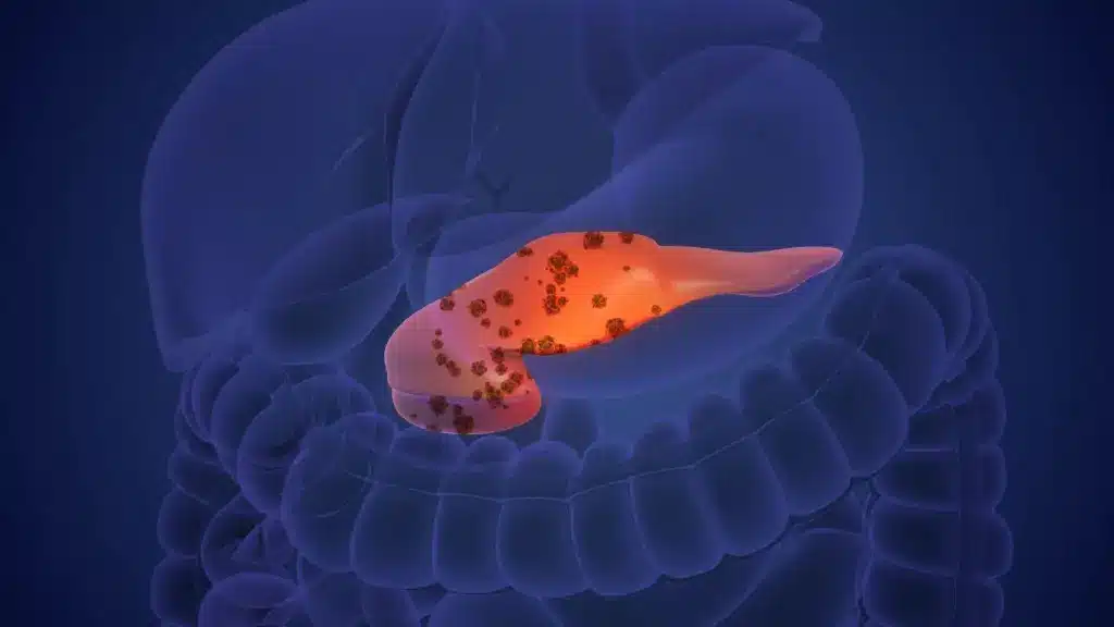 Colon Cancer Symptoms In Women: Amazing Tips 3 Colon Cancer Symptoms In Women: Amazing Tips