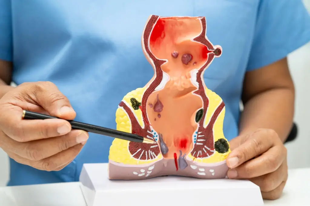 Rectum: Amazing Ways To Spot Scary Cancer