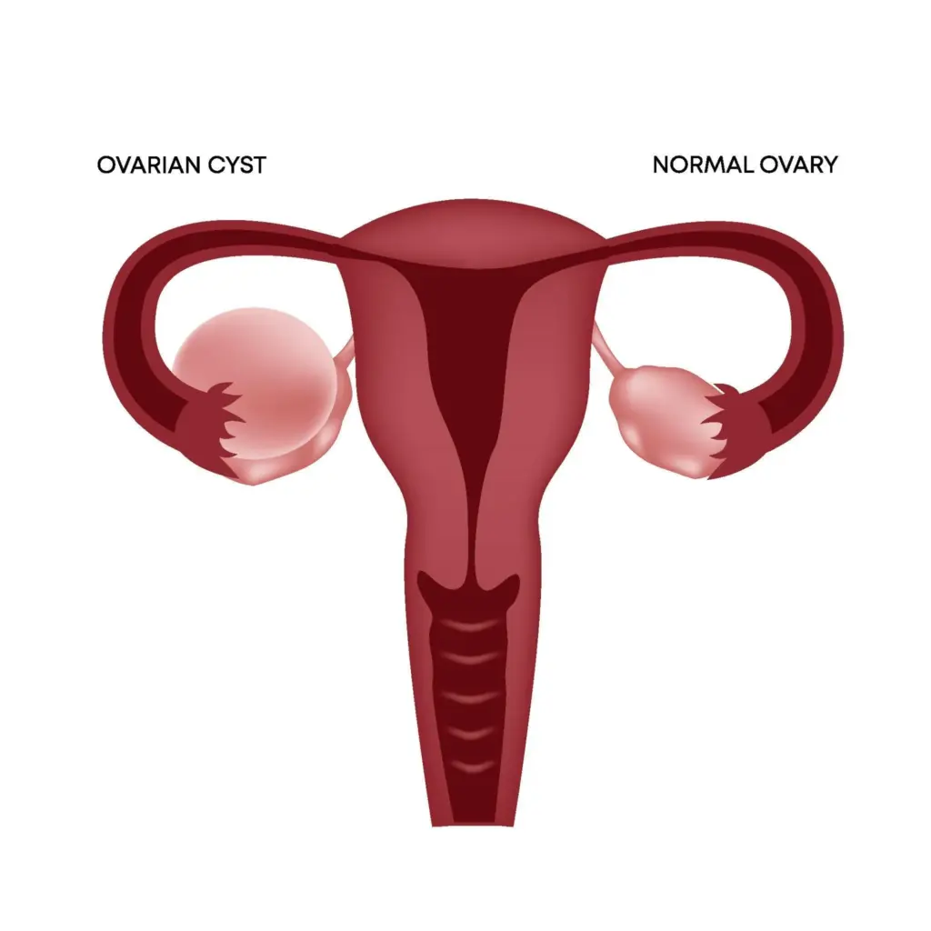 Ovarian Cancer: Amazing Facts On Scary Origins 1 Ovarian Cancer: Amazing Facts On Scary Origins