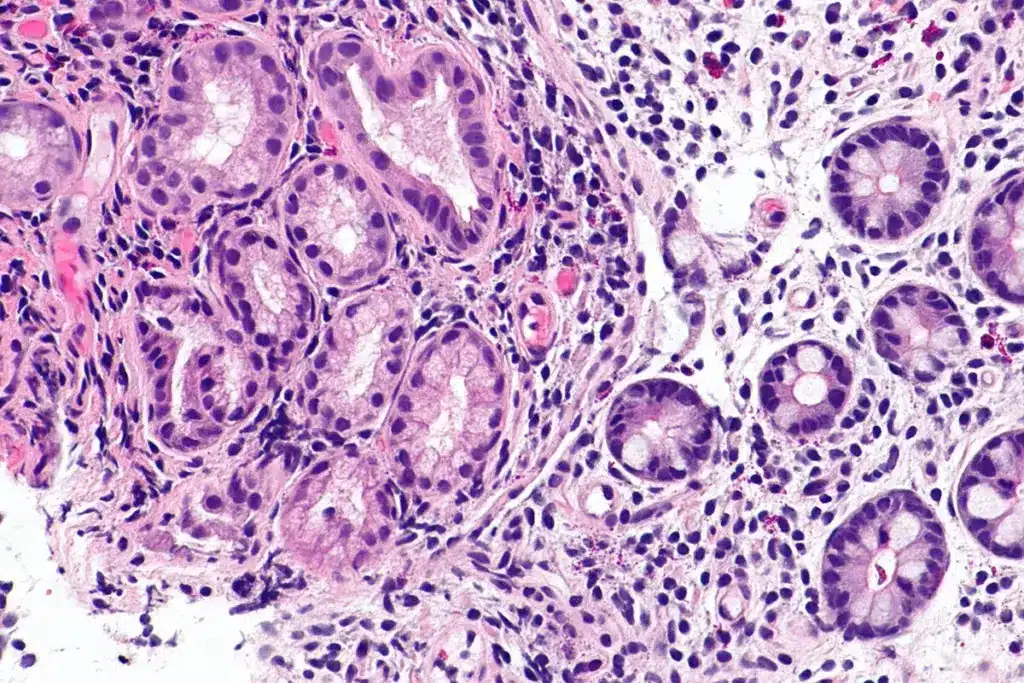 Throat Cancer Survival Rate: Amazing Success 2 Throat Cancer Survival Rate: Amazing Success