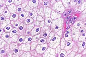 Squamous Cell Skin Cancer: Scary Delay Risks