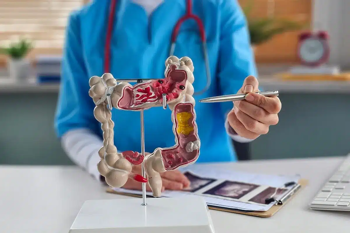 How Can You Get Bowel Cancer? 7 Alarming Risk Factors