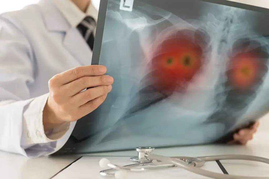 Lung Mass: Scary Differences From Tumors