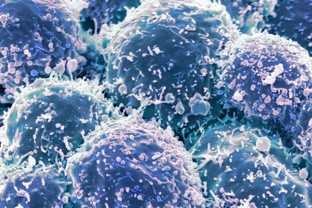 Lung Mass: Scary Differences From Tumors