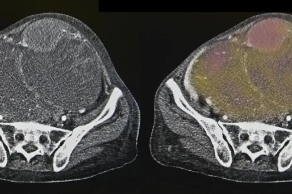 How To Check For Ovarian Cancer At Home: Tips 2 How To Check For Ovarian Cancer At Home: Tips